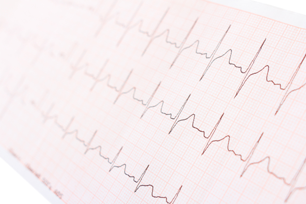 guidelines ECG HF stimulation Guidelines ECG HF Stimulation